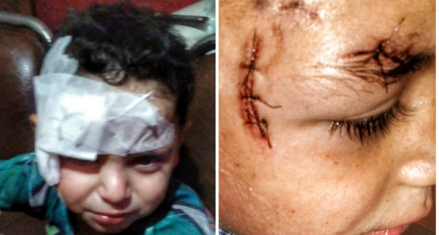 NENE DE 2 AÑOS ATACADO POR UN PERRO